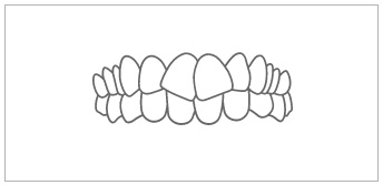 Alinhamento dos Dentes