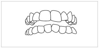 Dentes Apinhados